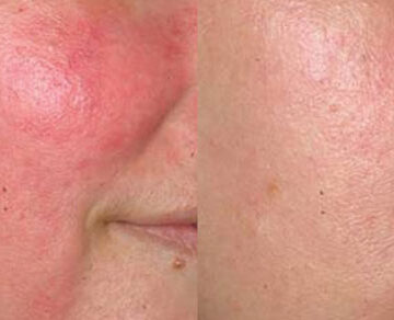 میکرو نیدلینگ