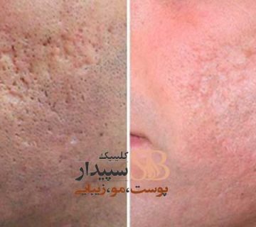 لیز CO2 فرکشنال