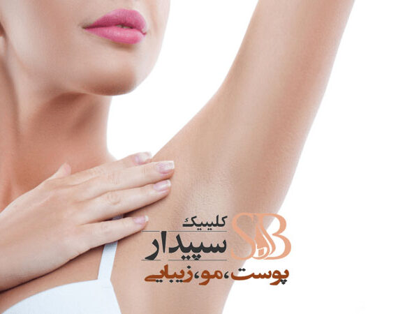 لیزر موهای زائد