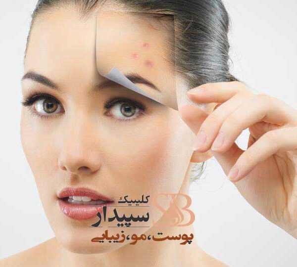 برداشتن خال با لیزر