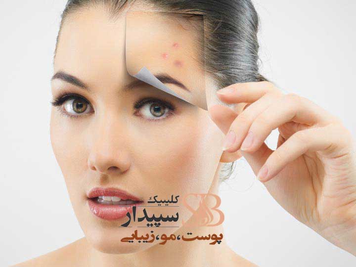 برداشتن خال با لیزر