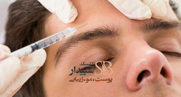 بوتاکس برای میگرن