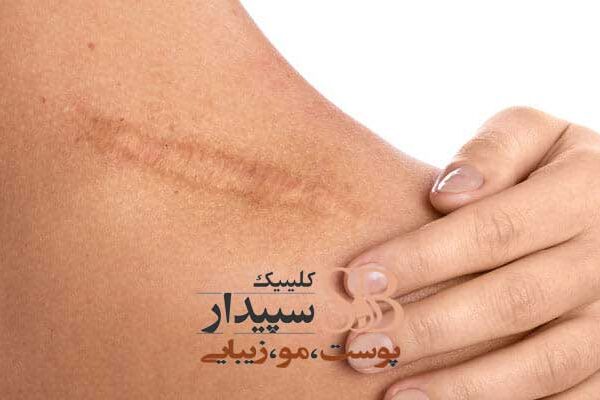 لیزر جای بخیه