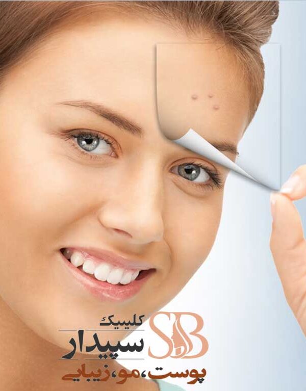 لیزر جای جوش