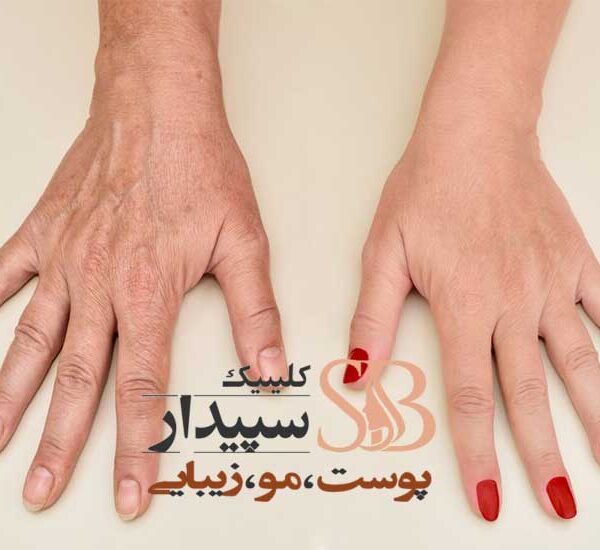 جوانسازی پوست دست