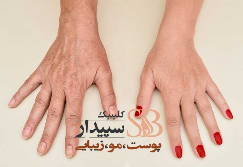 جوانسازی پوست دست