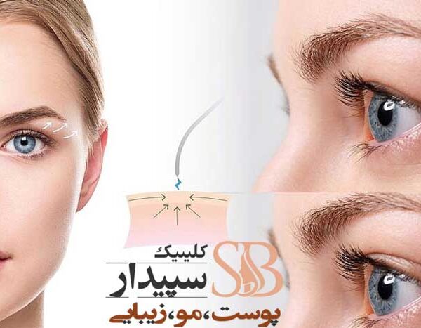 بوتاکس برای افتادگی پلک