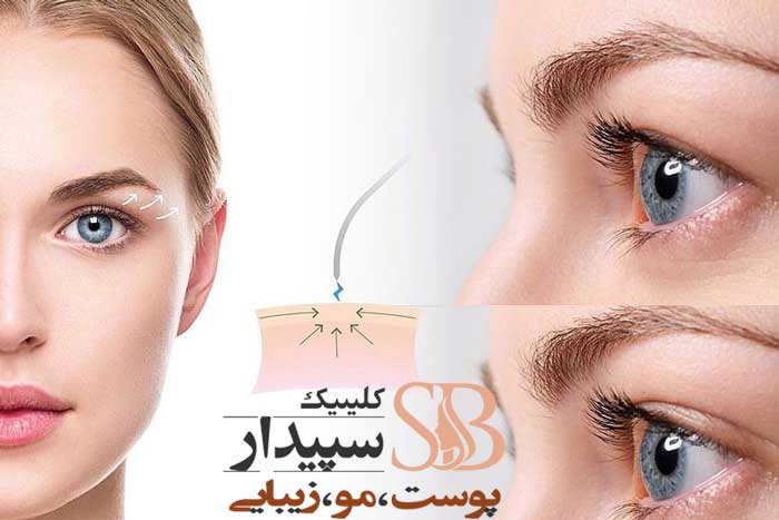 بوتاکس برای افتادگی پلک