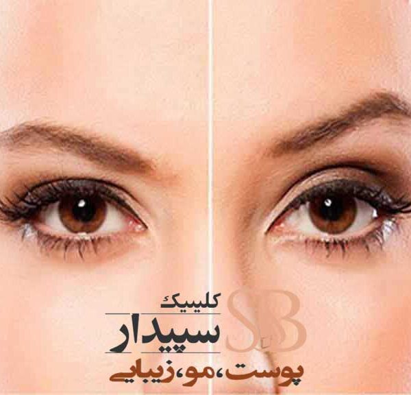 لیفت چشم و ابرو