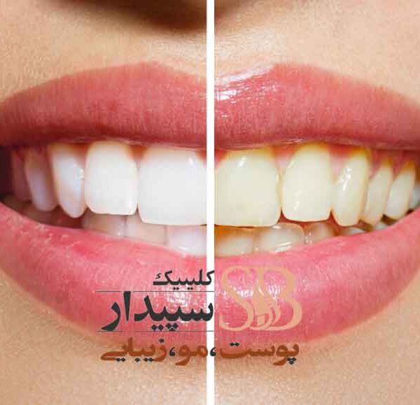 بلیچینگ دندان