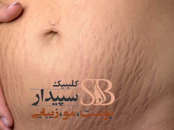 پلاسما جت ترک شکم