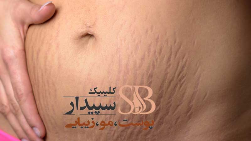 پلاسما جت ترک شکم