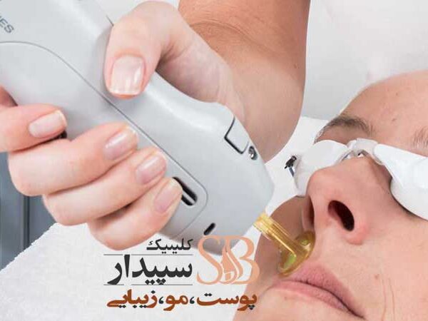 لیزر مو تهرانپارس