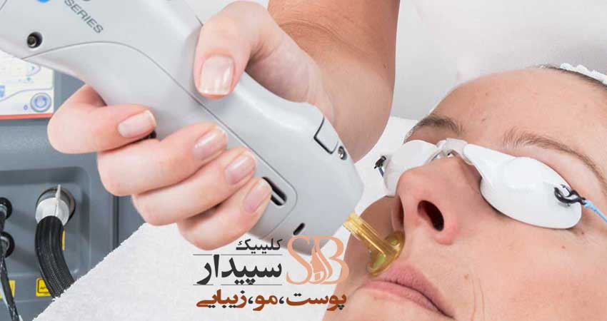 لیزر مو تهرانپارس