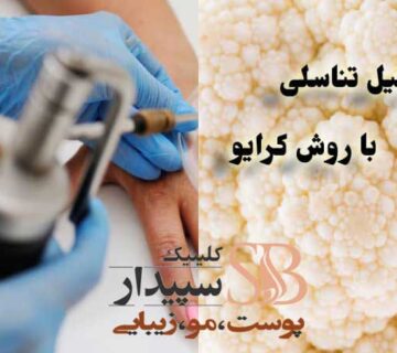 کرایو زگیل تناسلی