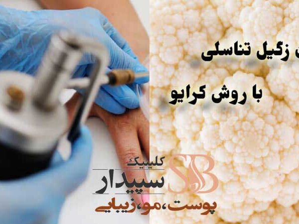 کرایو زگیل تناسلی