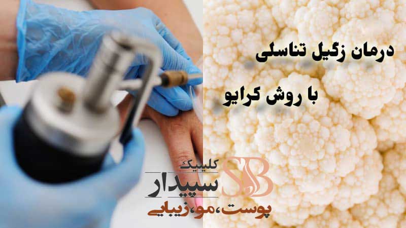کرایو زگیل تناسلی