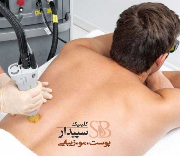 لیزر شکم و کمر