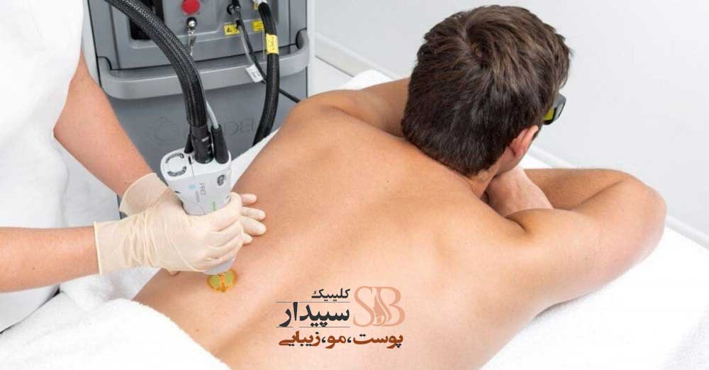 لیزر شکم و کمر