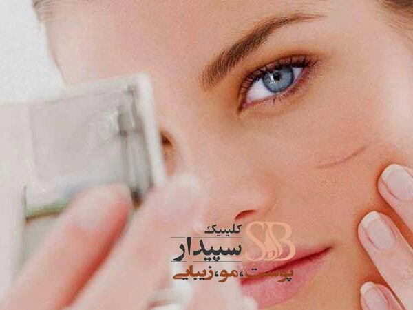 لیزر جای بخیه