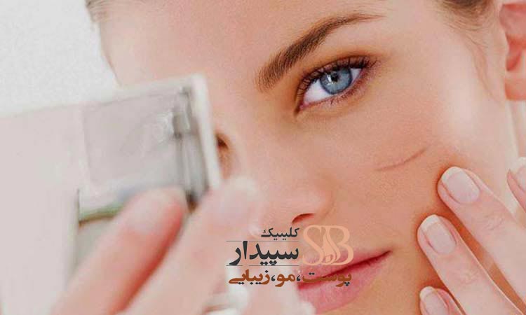 لیزر جای بخیه