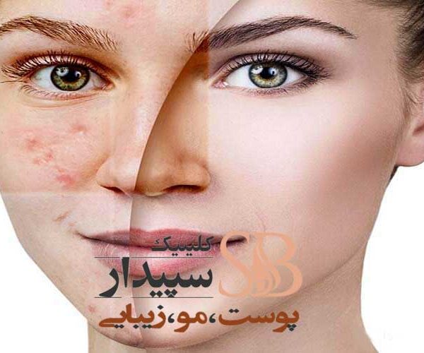 لیزر CO2 فرکشنال