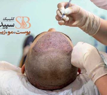 کاشت مو شرق تهران