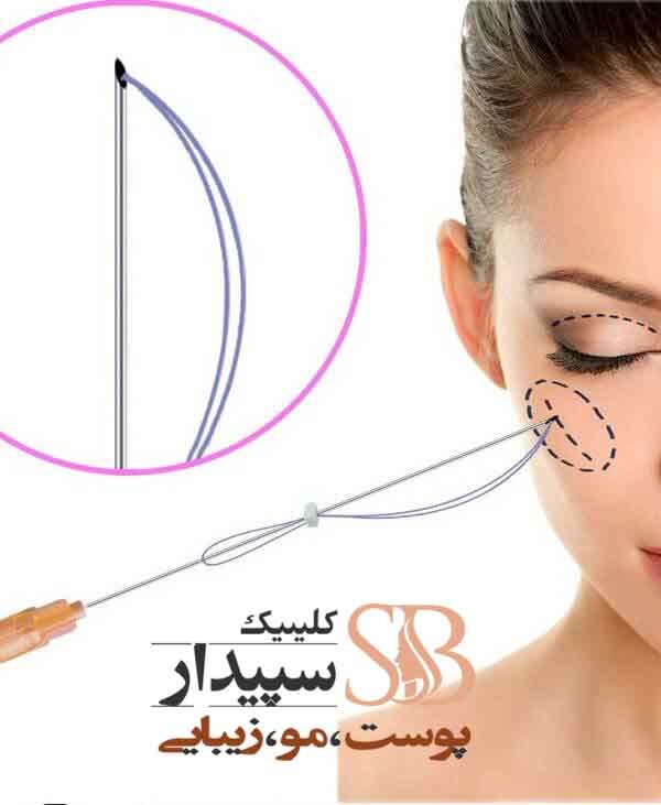 لیفت صورت با نخ تهرانپارس