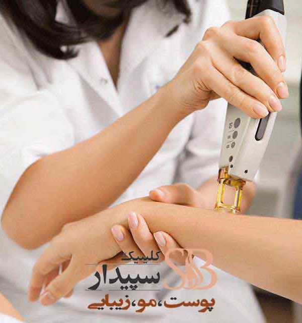لیزر دست و پا شرق تهران