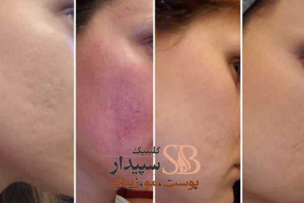 میکرو نیدلینگ تهرانپارس