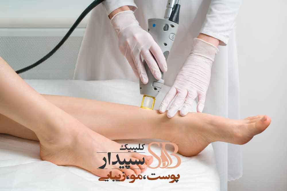 لیزر موهای زائد شرق تهران