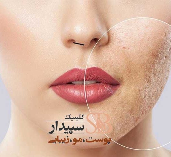 مزوتراپی تهرانپارس