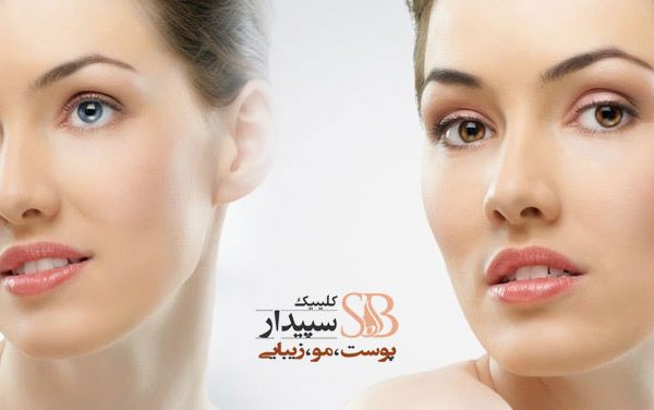 بهترین مرکز برداشتن خال با لیزر