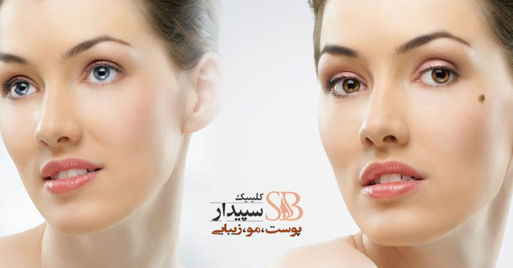 بهترین مرکز برداشتن خال با لیزر