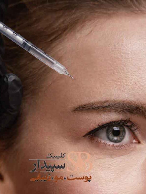 بوتاکس پیشانی