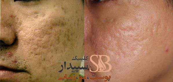 لیز CO2 فرکشنال تهرانپارس