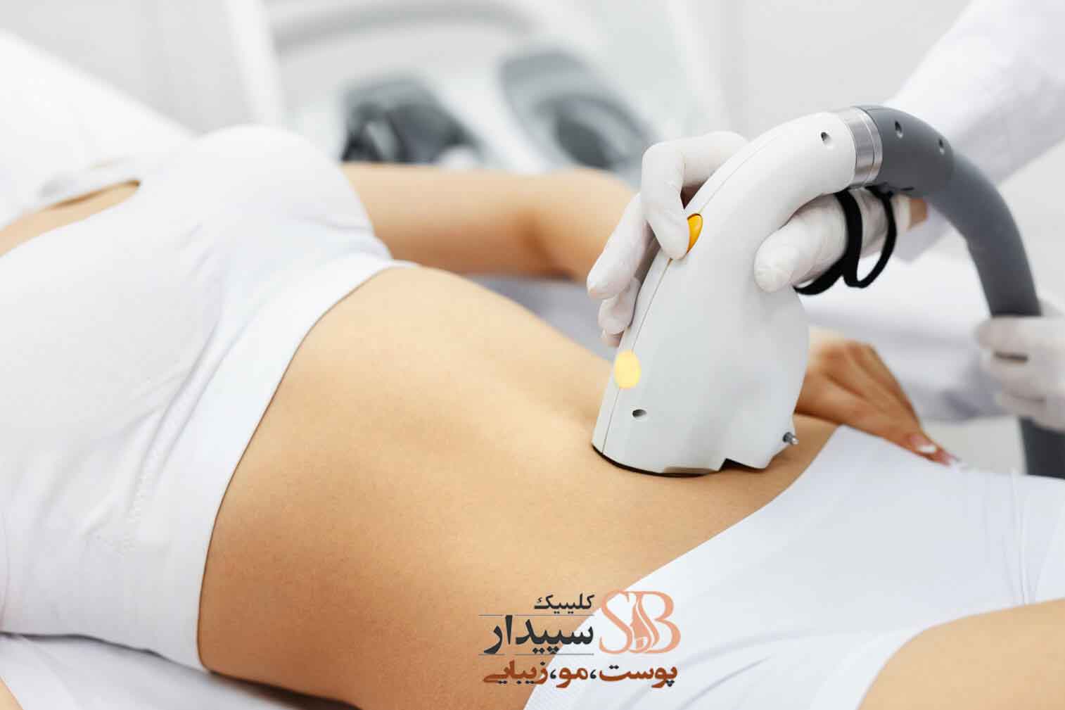 لیزر شکم و کمر تهرانپارس