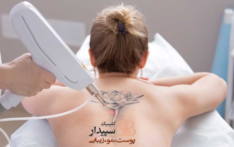 لیزر کیوسوئیچ