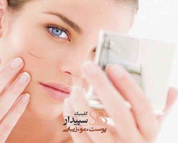 لیزر جای بخیه با لیز CO2 فرکشنال