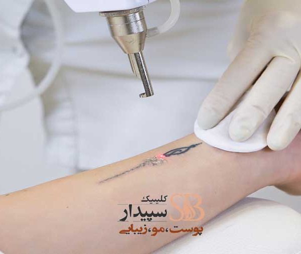 لیزر کیوسوئیچ