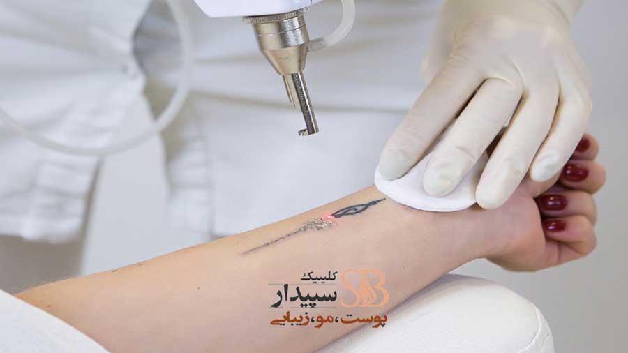 لیزر کیوسوئیچ