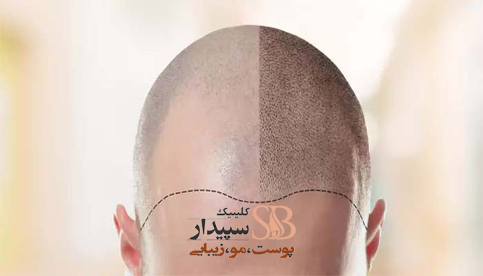بهترین کلینیک کاشت مو تهرانپارس