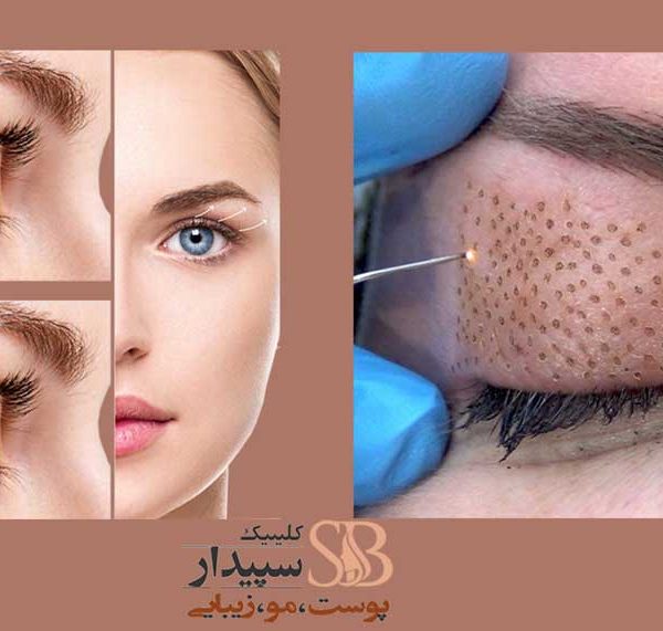 پلاسما جت شرق تهران (پلاسما جت تهرانپارس)