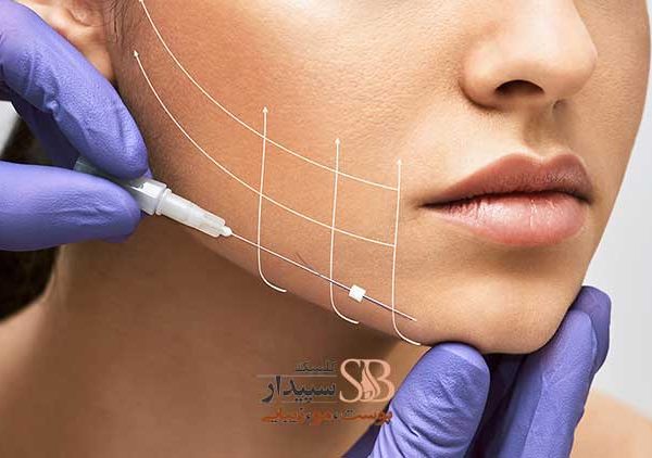لیفت صورت با نخ