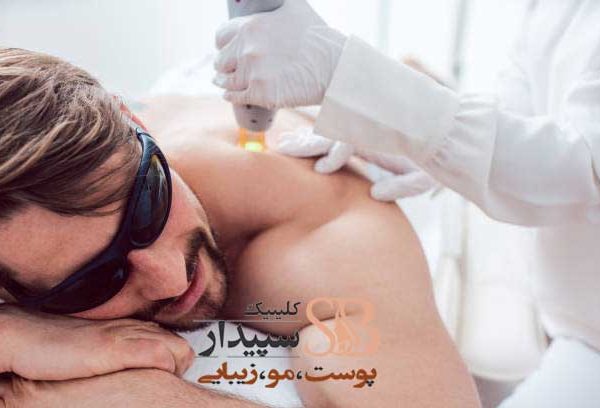 لیزر موهای زائد آقایان