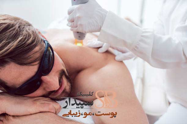 لیزر موهای زائد آقایان