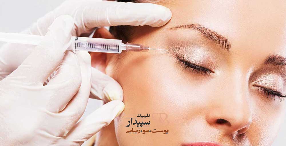 بوتاکس دور چشم