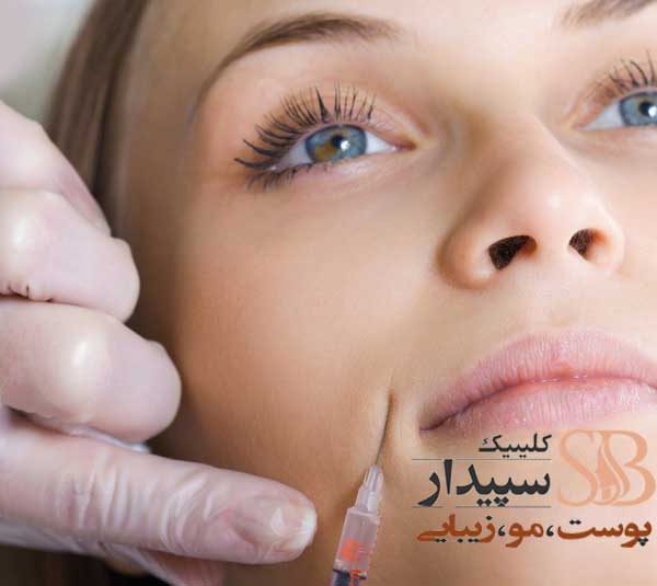 بوتاکس خط لبخند