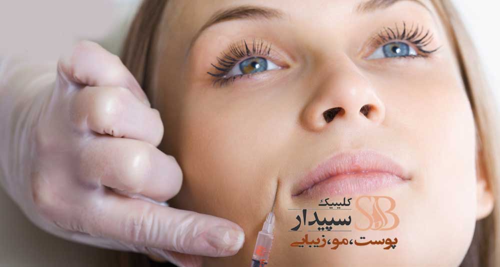 بوتاکس خط لبخند