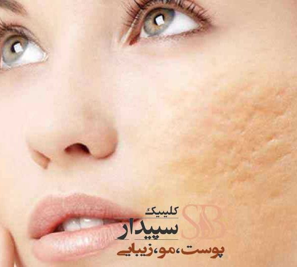 رفع اسکار آکنه و جای جوش